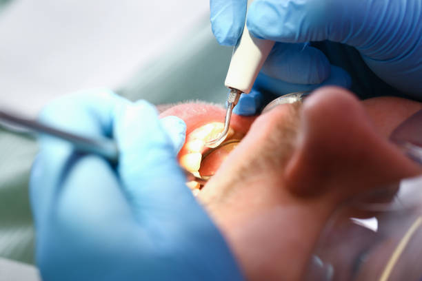 Best Emergency Tooth Extraction in Morris, IL